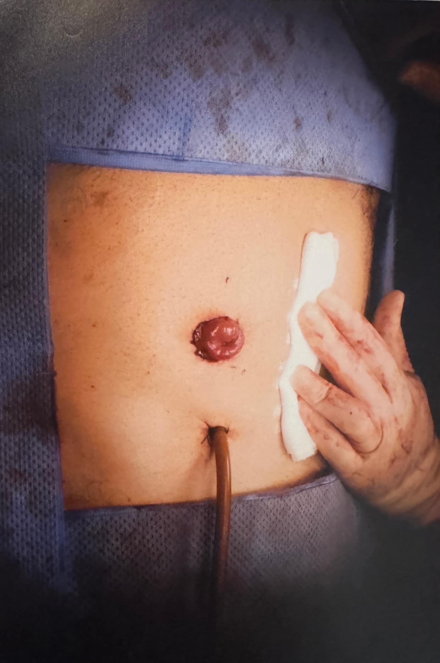 Ileostomía terminal — vista del estoma del íleon exteriorizado en la pared abdominal