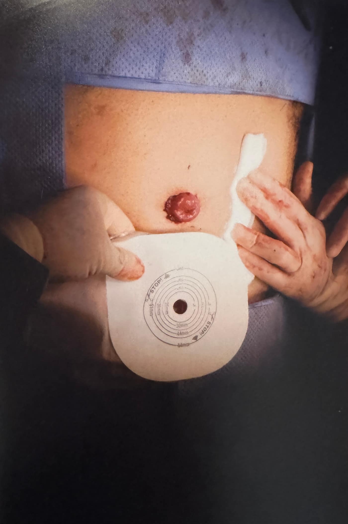 Ileostomía terminal — detalle del dispositivo de recolección adaptado al estoma